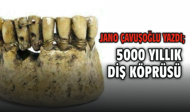 5000 yıllık Diş Köprüsü